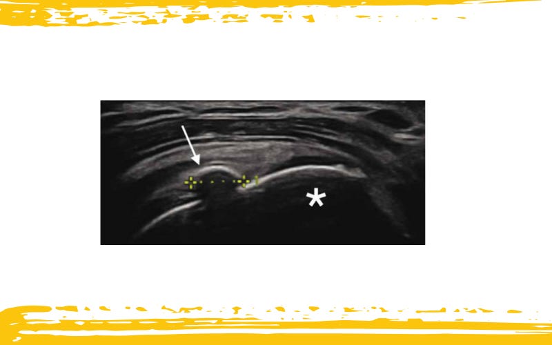 Calcificacion tmpo formacion 1.jpg